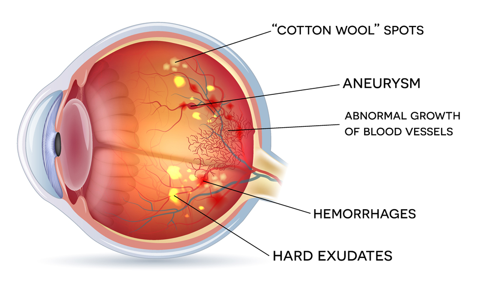 Exeter Eye Diabetic Retinopathy side view of eye diagram