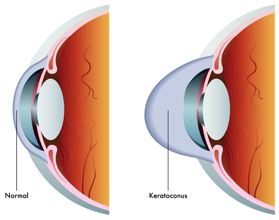 Exeter Eye Keratoconus diagram