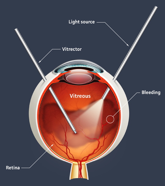 Exeter Eye Vitrectomy diagram