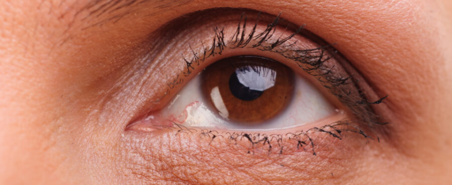 Blepharoplasty (Eyelid surgery)