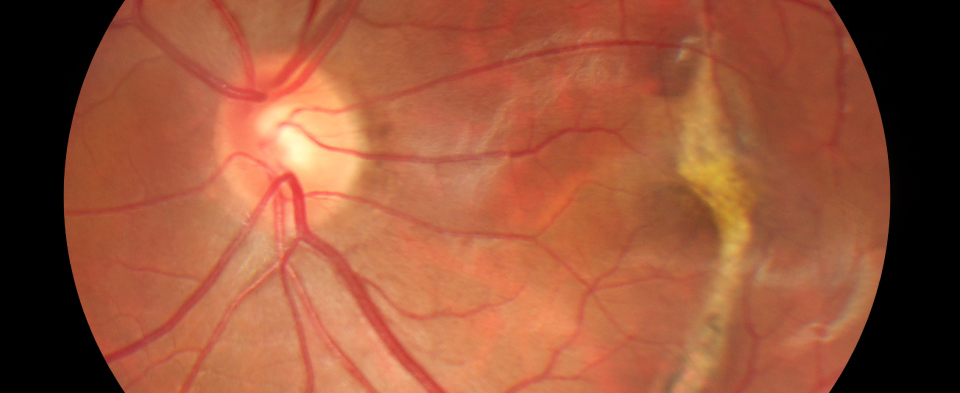 Exeter Eye conditions macular degeneration