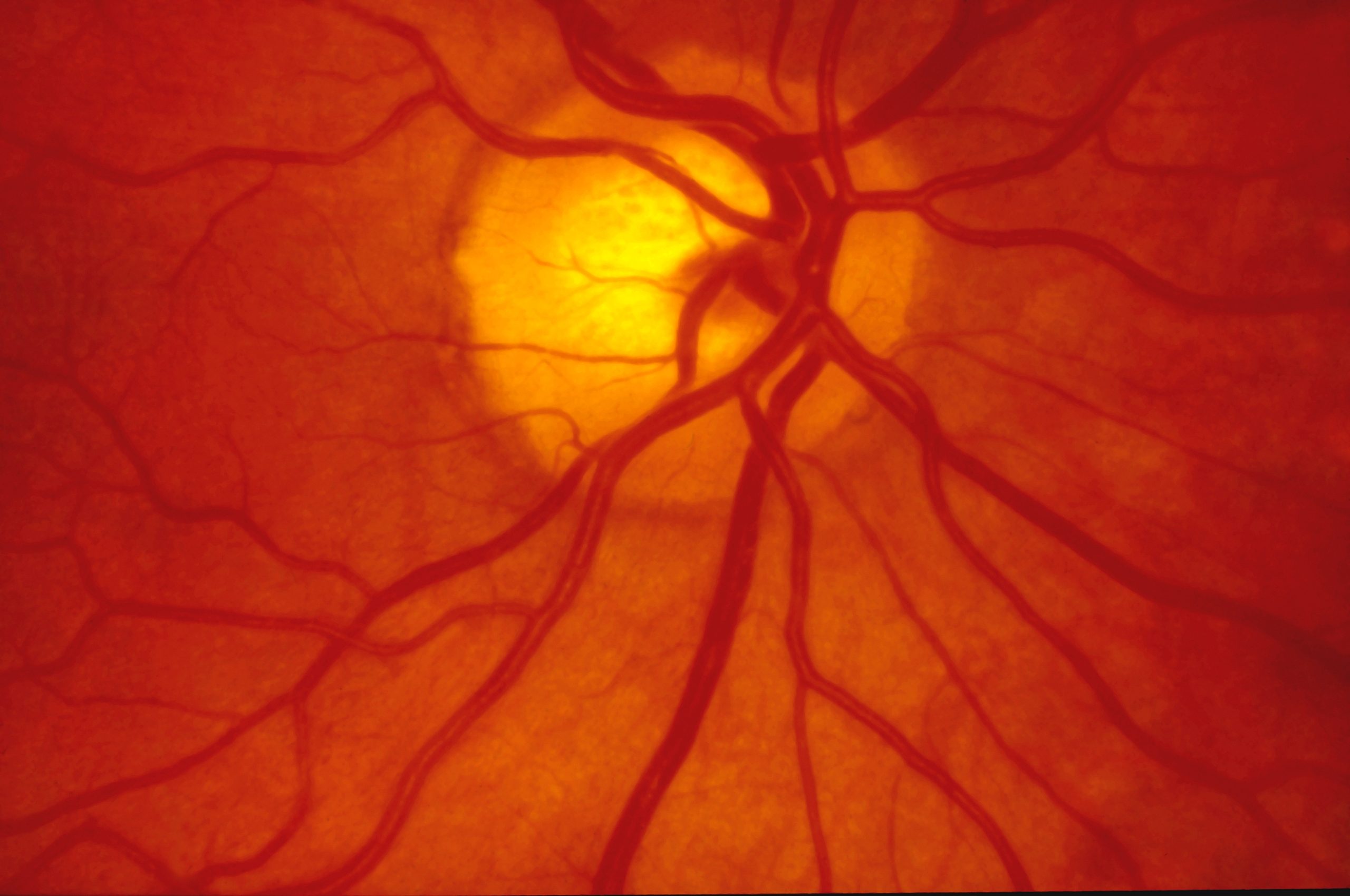 Normal human retina